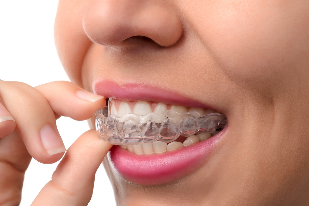 L’orthodontie en 5 questions