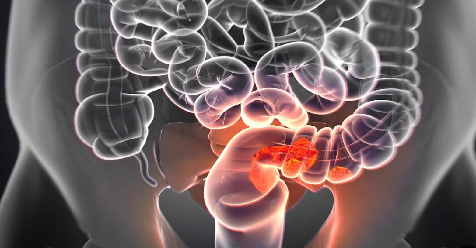  Un accès plus facile au dépistage du cancer colorectal