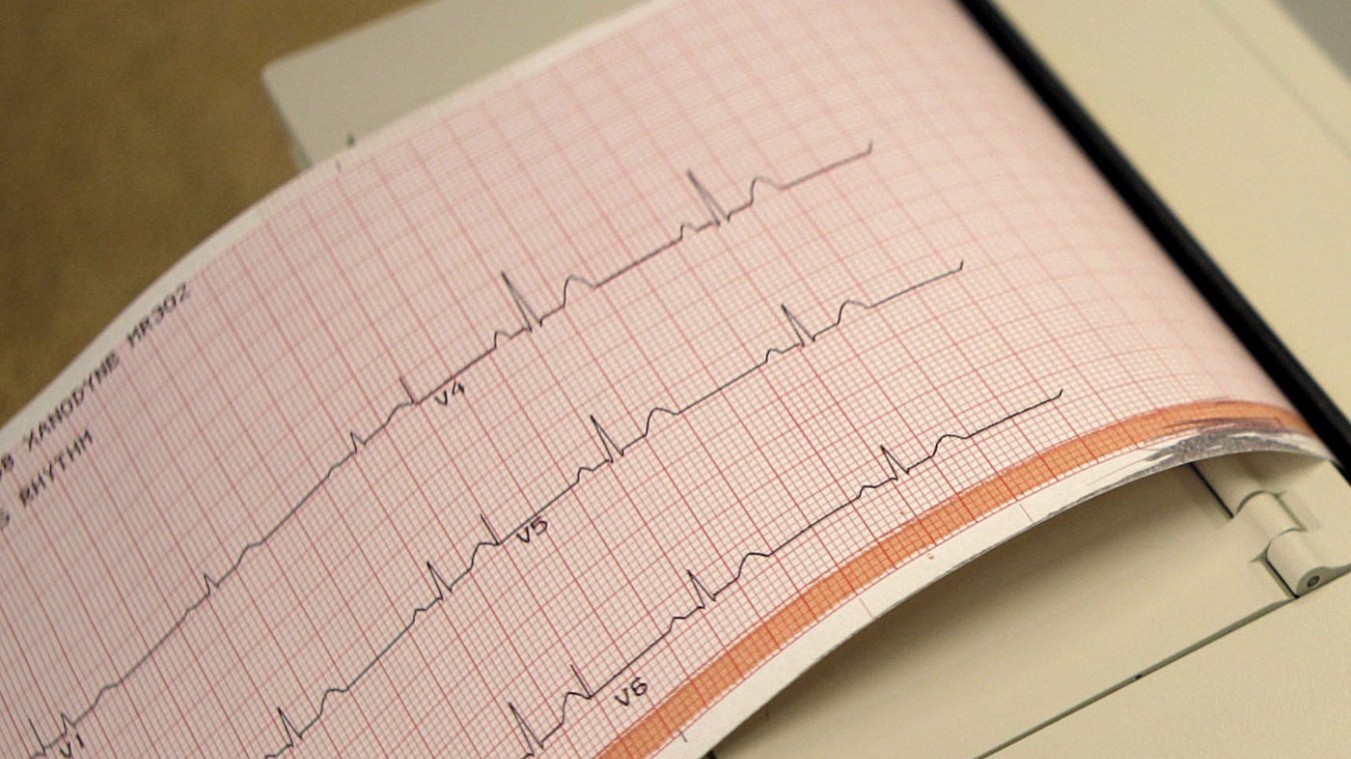 Des plaques d'athérosclérose sont présentes dès 30 ou 40 ans, dit une étude