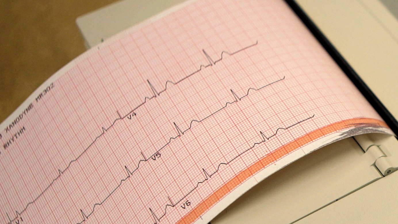 FA: l'Institut de cardiologie de Montréal réalise une première canadienne