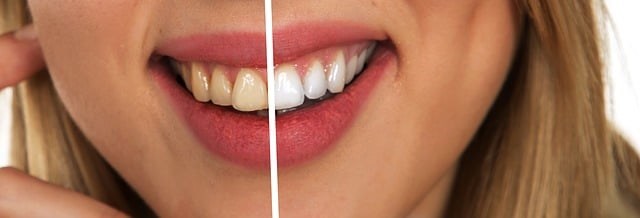 Tout ce qu’il faut savoir sur la pose de facettes dentaires