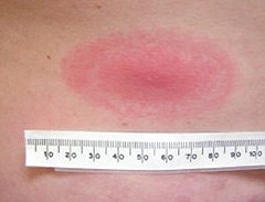 Rappel de santé publique : maladie de Lyme