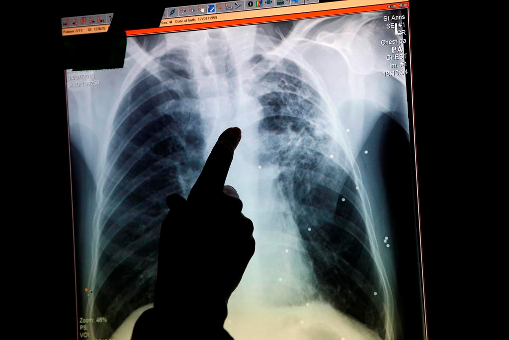 La mortalité due au cancer du poumon est en chute libre au Canada