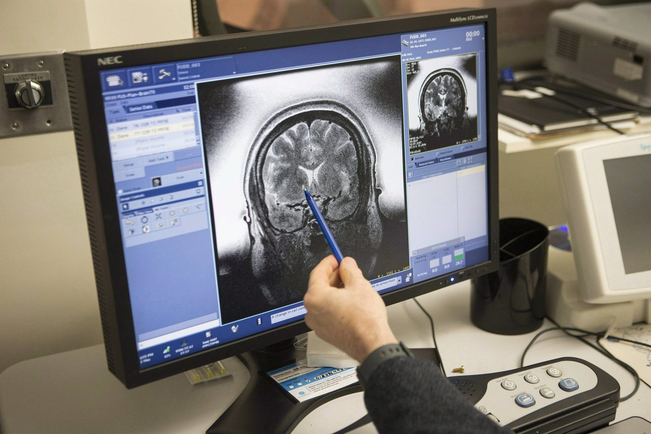 L'anorexie associée à des altérations majeures du cerveau