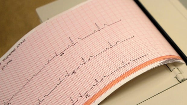 FA: l'Institut de cardiologie de Montréal réalise une première canadienne