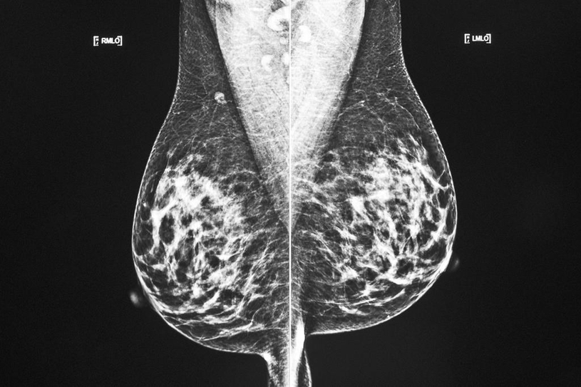 Cancer du sein: survie et qualité de vie s'améliorent constamment