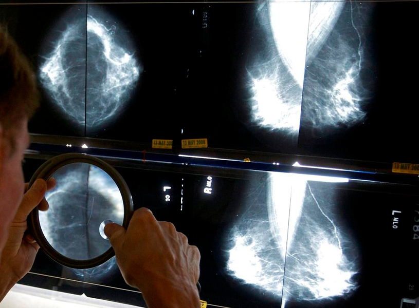 La Société canadienne du cancer réclame le dépistage du cancer du sein dès 40 ans