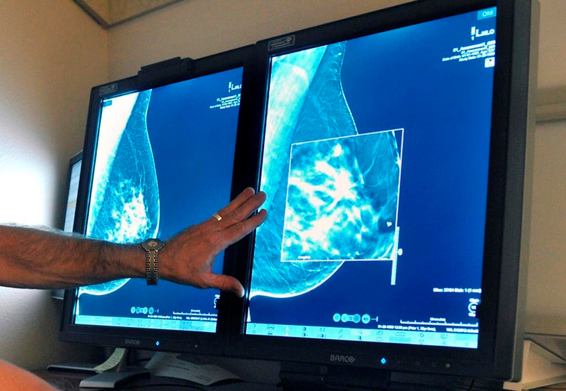 Le dépistage précoce du cancer du sein permettrait d'économiser des millions
