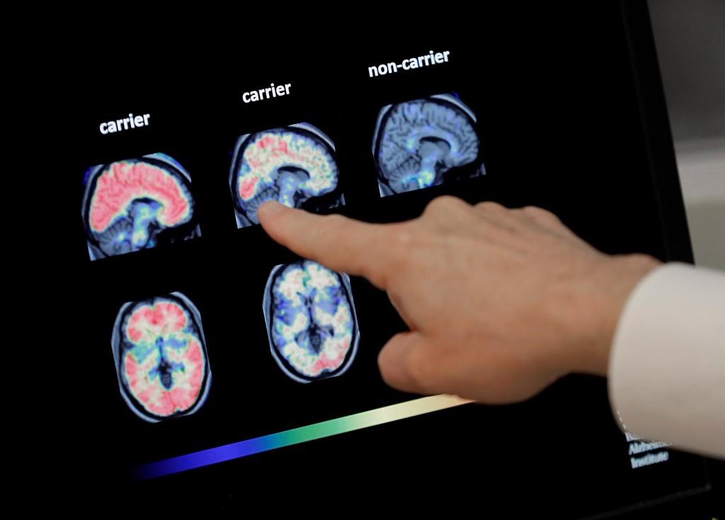 Alzheimer et autre: on pourrait être en mesure de faire disparaître les dépôts de tau