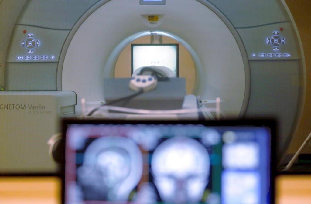 Vaste étude internationale sur le dépistage précoce du parkinson