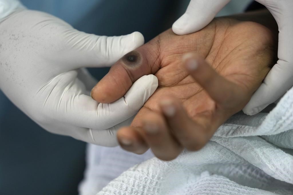 La santé publique rapporte de nouveaux cas de mpox diagnostiqués à Montréal