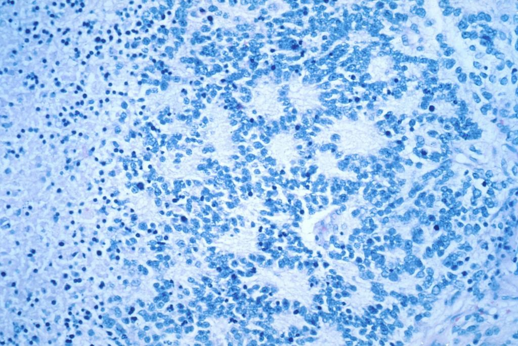 Un médicament contre l'alcoolisme pourrait combattre le neuroblastome