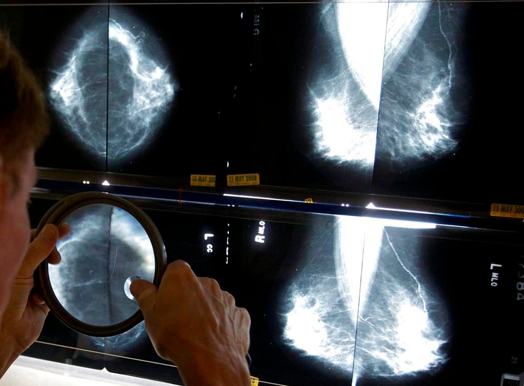 Cancer du sein: dépistage gratuit désormais élargi aux Québécoise de 70 à 74 ans