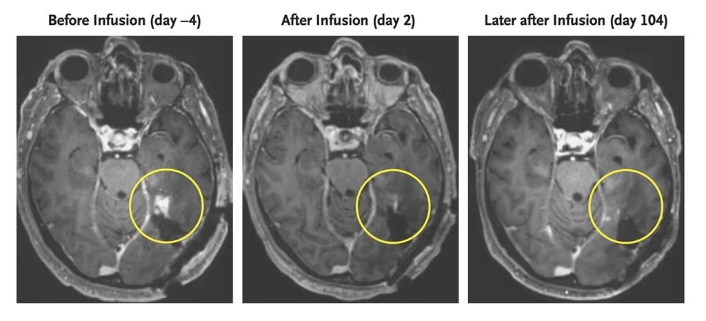 Percée prometteuse dans le traitement du glioblastome