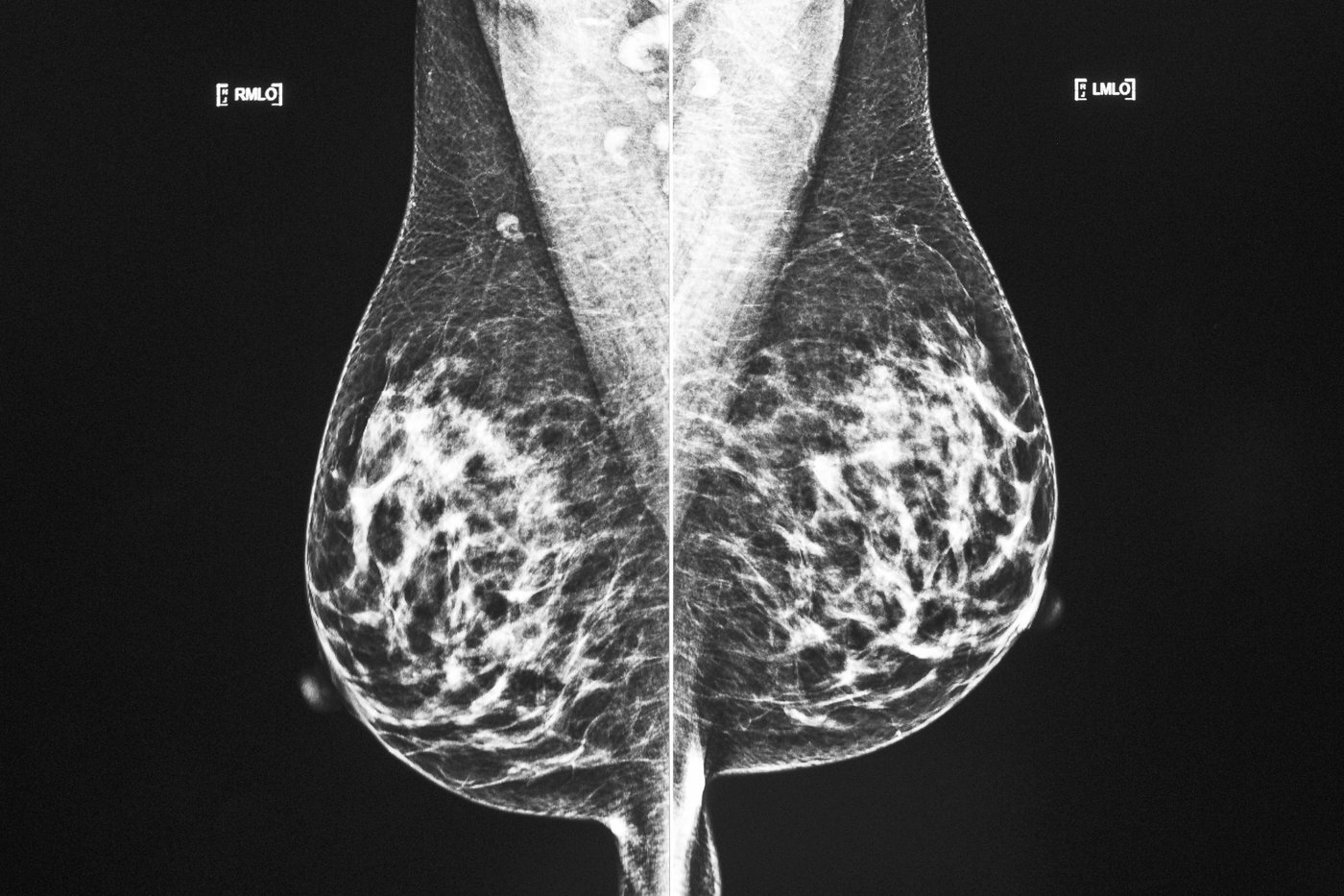 Cancer: les traitements moins invasifs gagnent de plus en plus de terrain