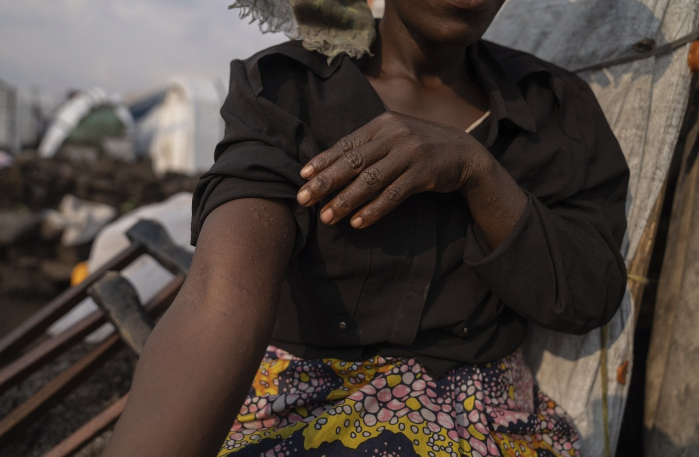 Épidémie de variole simienne en Afrique: «il peut y avoir des débordements au Canada»