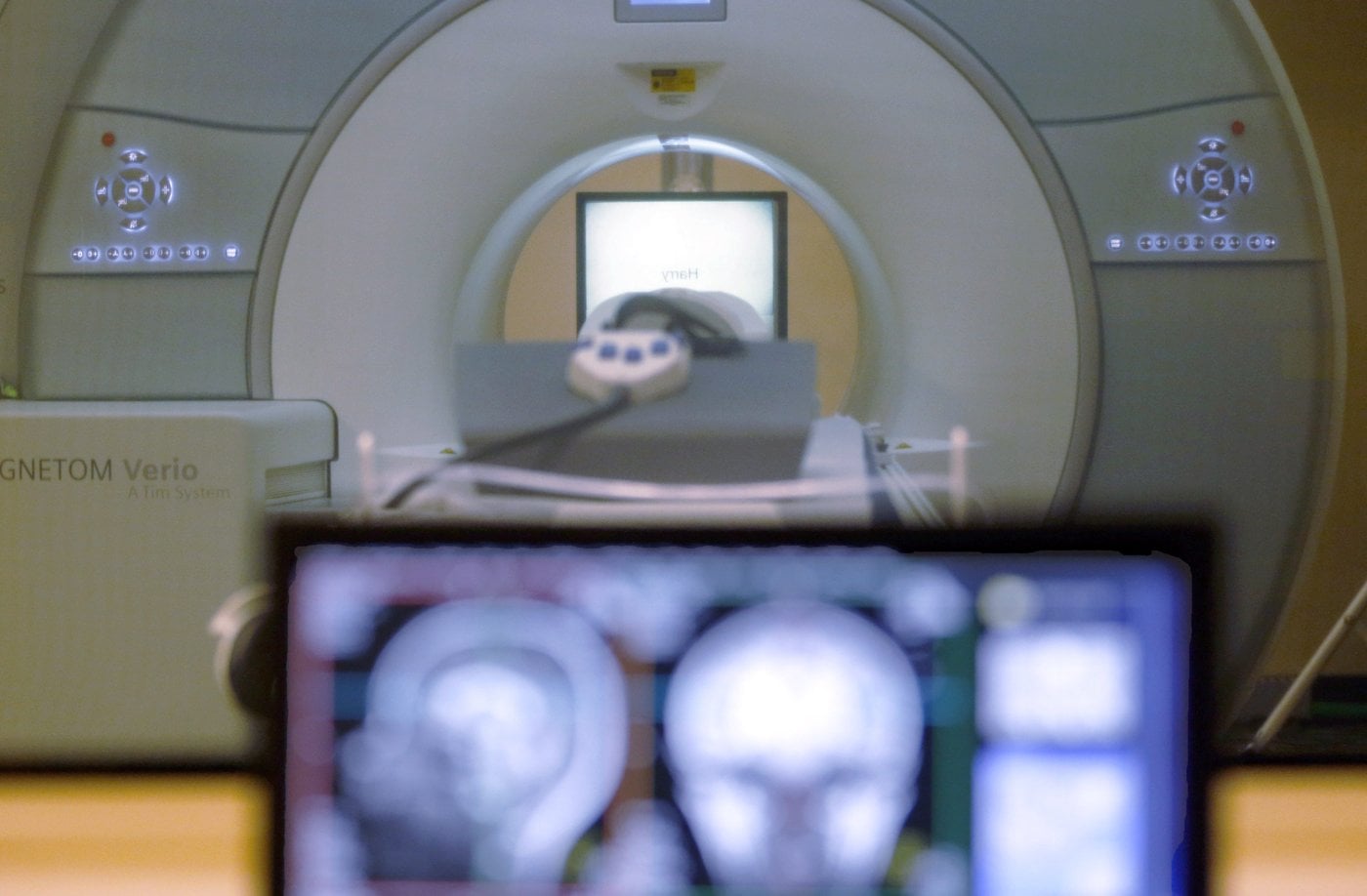 Une étude expliquerait pourquoi l'immunothérapie échoue face au cancer du cerveau
