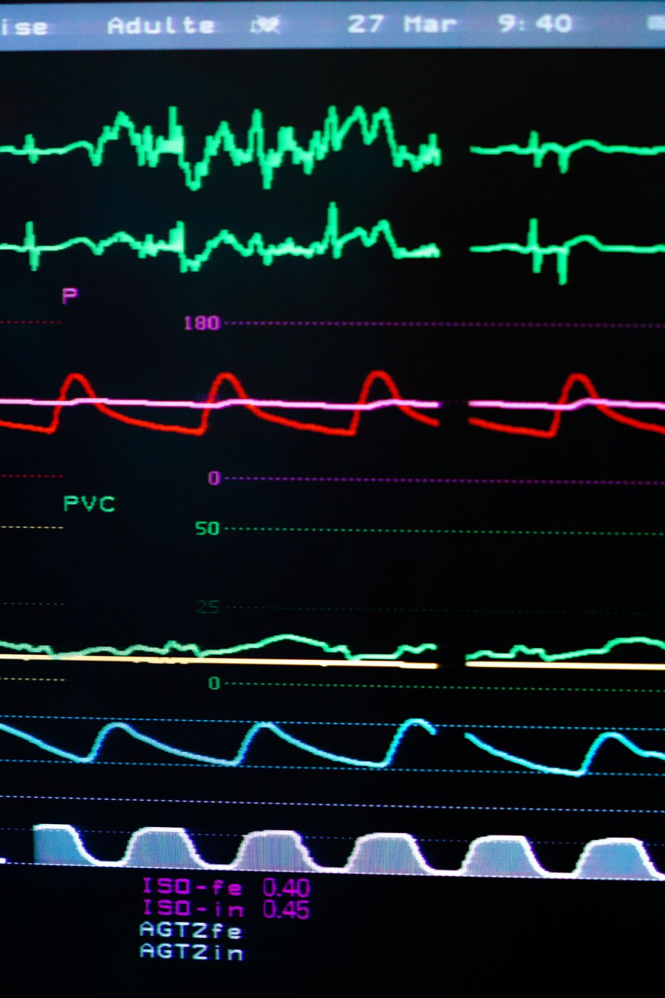 Les maladies auto-immunes augmentent le risque de décès cardiovasculaire des femmes