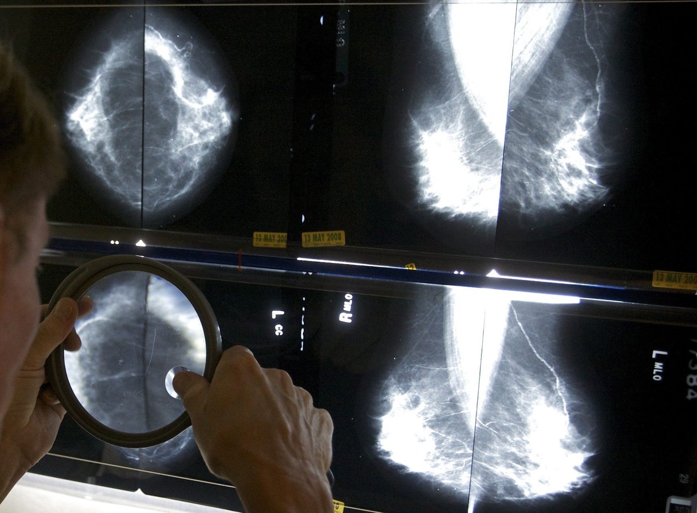 Cancer du sein: une seconde option de traitement pour les récidives est approuvée