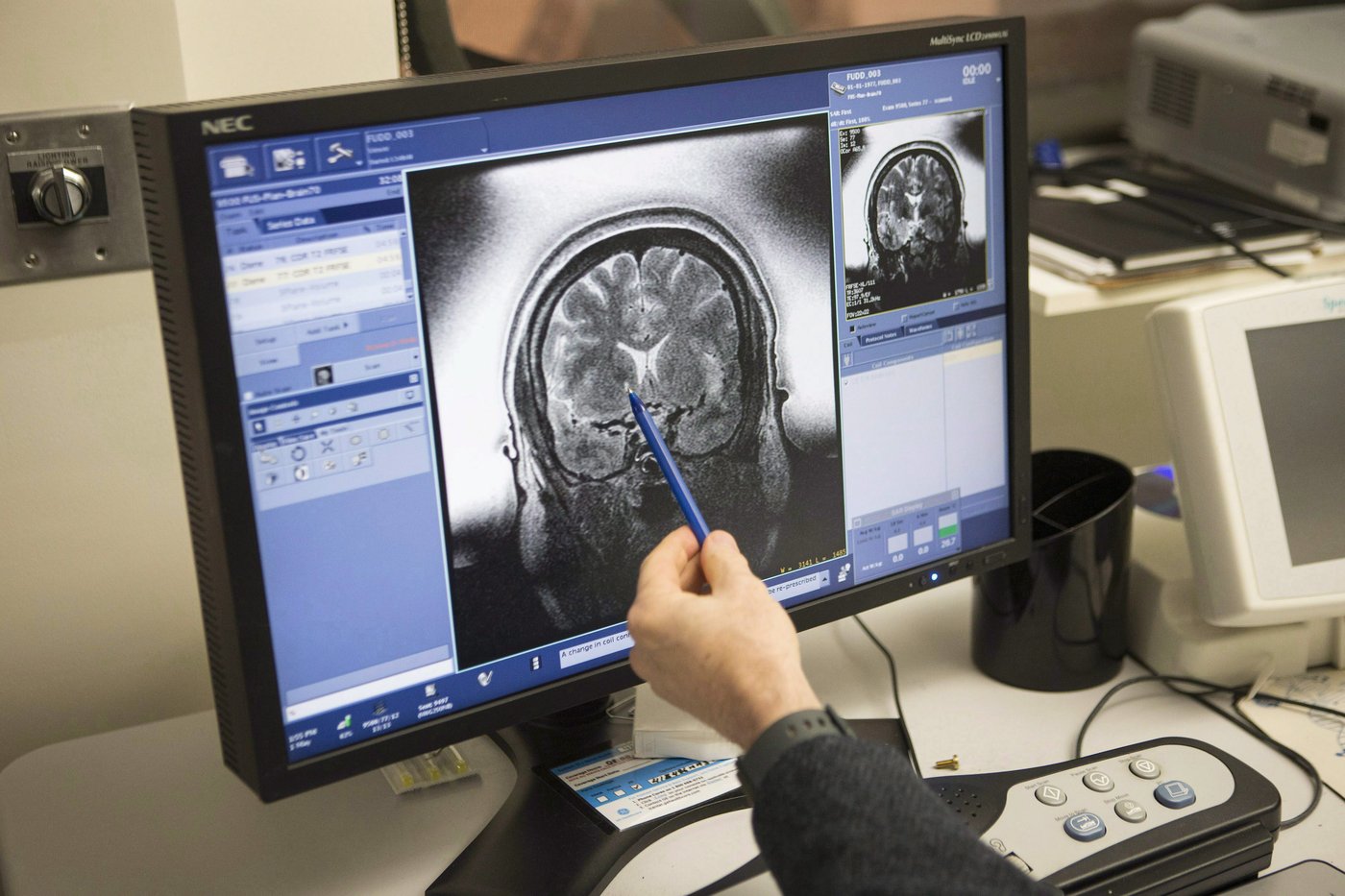 L'anorexie associée à des altérations majeures du cerveau