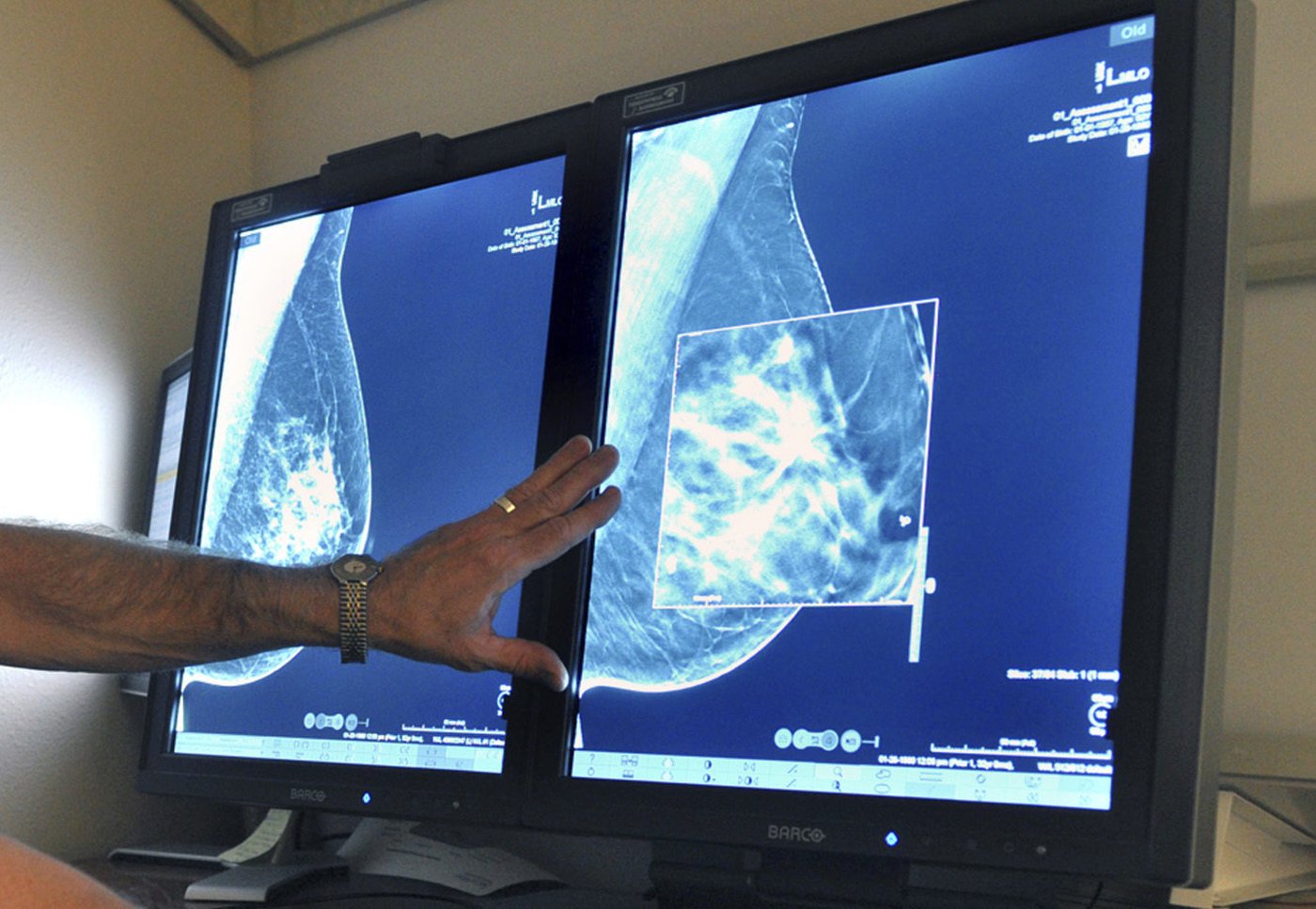 Vers un nouveau test à domicile pour connaître son risque d'avoir un cancer du sein