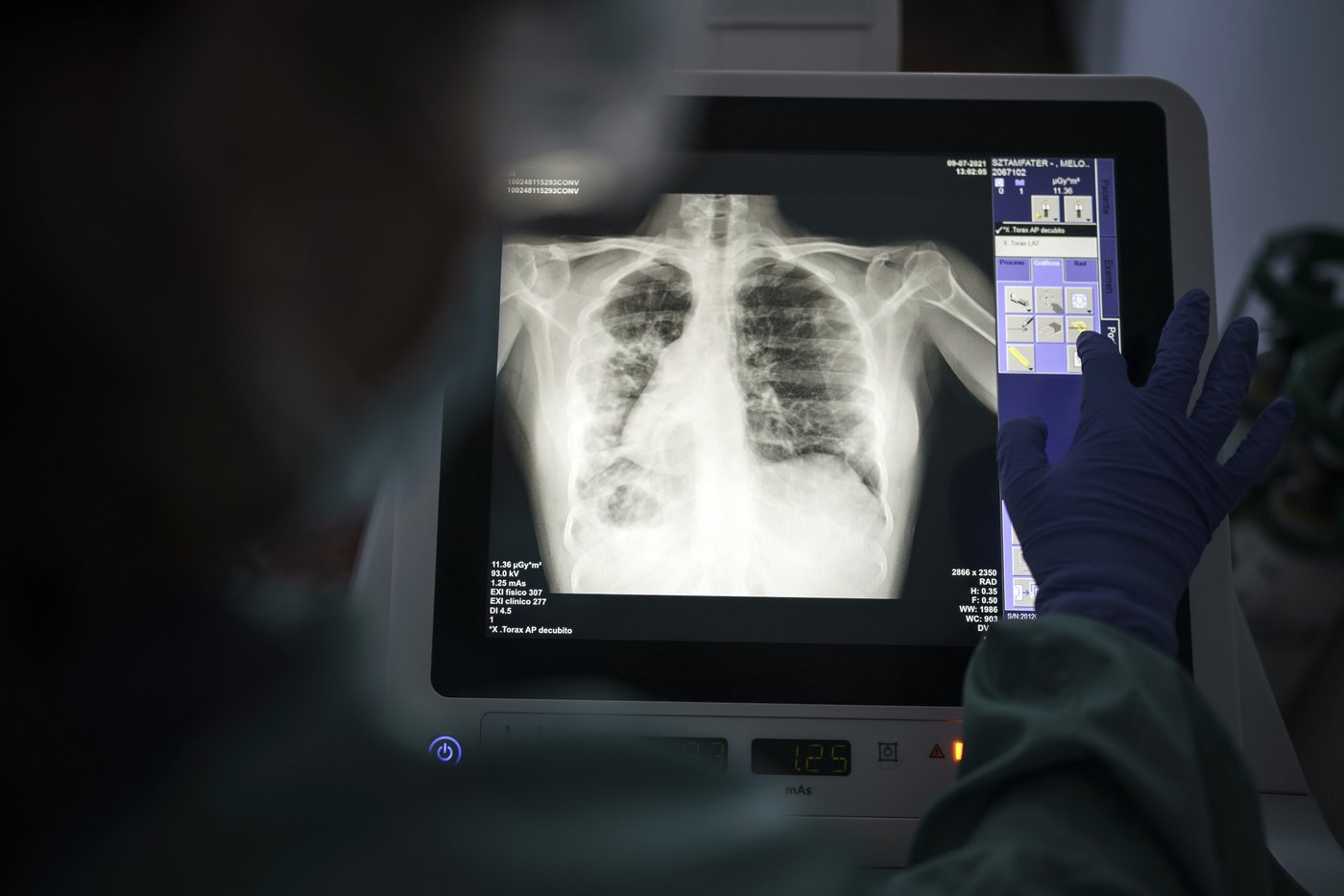 Le retour de maladies infectieuses de jadis qui étaient presque disparues au Canada