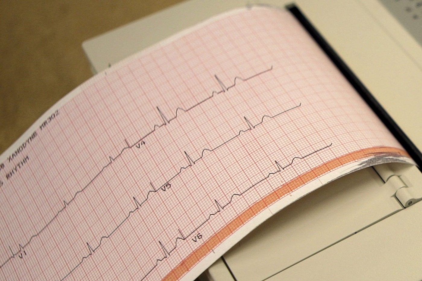 Une nouvelle technologie augmente le nombre de cœurs pouvant être greffés à l'ICM
