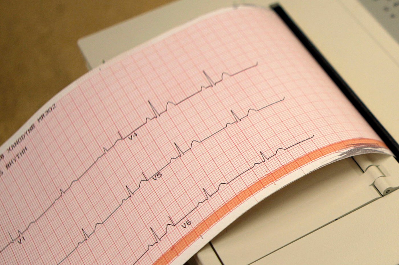 FA: l'Institut de cardiologie de Montréal réalise une première canadienne