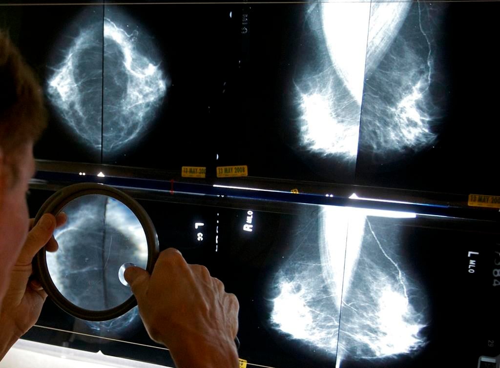 Une étude suggère un dépistage moins fréquent pour les survivantes du cancer du sein